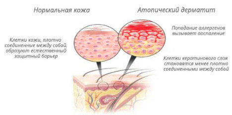 Атопический дерматит у взрослых - симптомы и лечение: комплексные меры